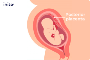 posterior placenta