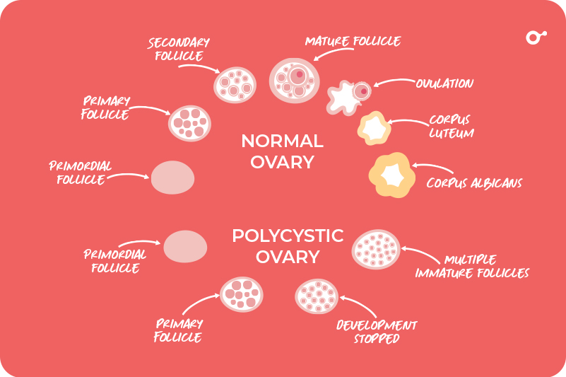 PCOS Affect Ovulation