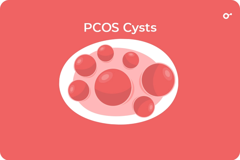 Polycystic ovary syndrome (PCOS)