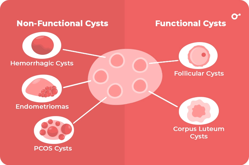 Types of ovarian cysts