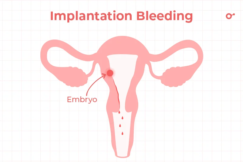First trimester bleeding