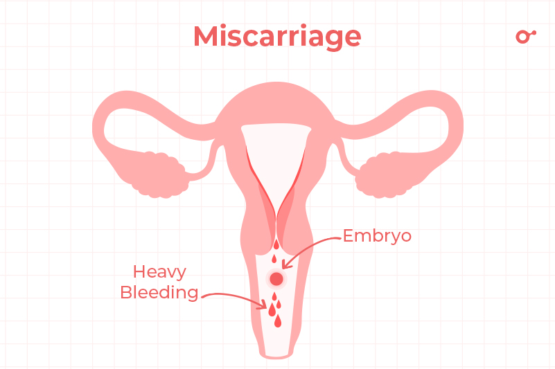 Miscarriage