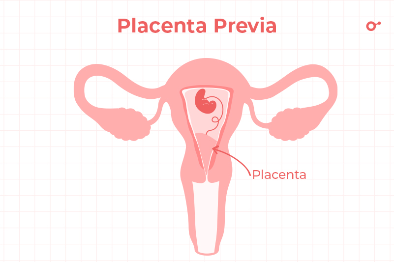 Placenta previa