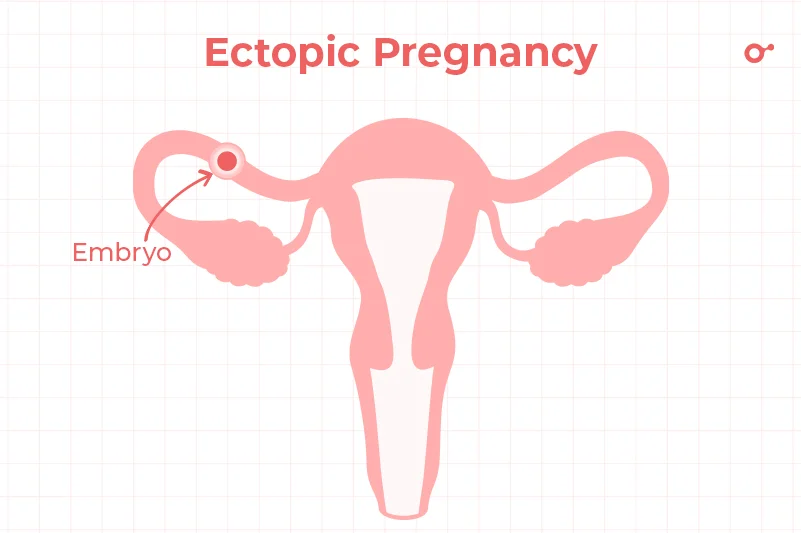 ectopic pregnancy