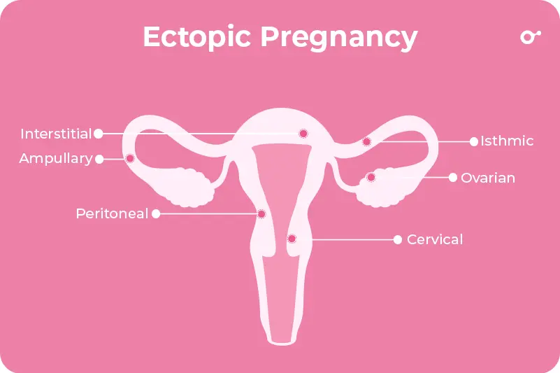 Ectopic pregnancy