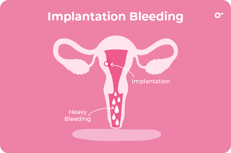 Medicover Fertility - Implantation bleeding is the pink or brown