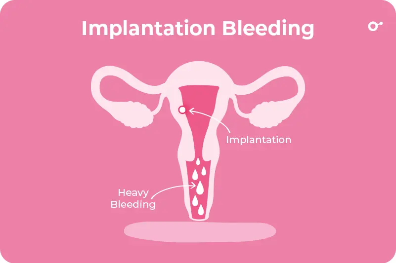 Implantation Bleeding