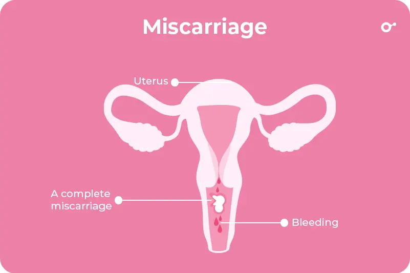 Miscarriage