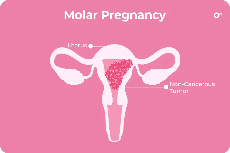 Molar pregnancy