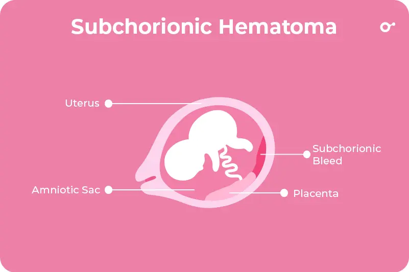 Subchorionic Hematoma