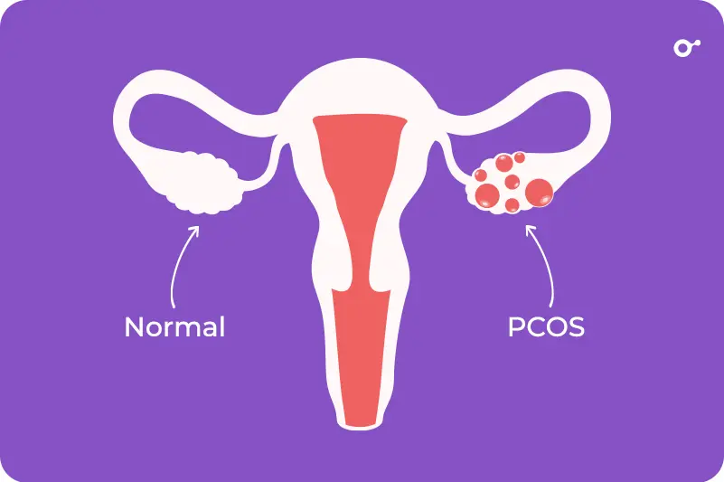 Polycystic ovary syndrome (PCOS)