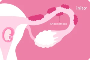 Getting Pregnant With Endometriosis