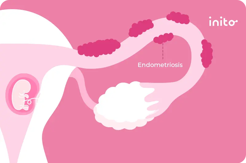 Getting Pregnant With Endometriosis