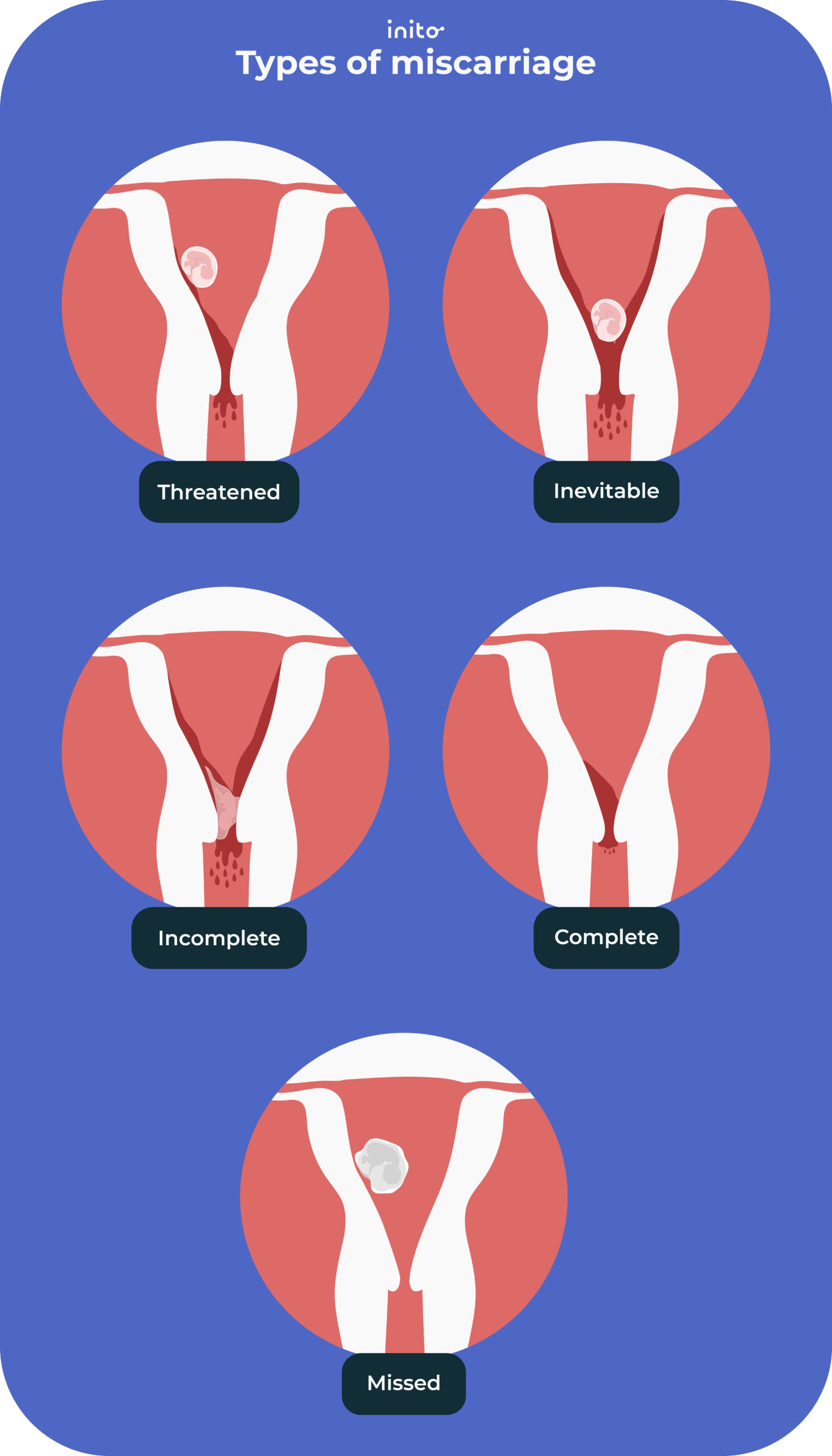 Other types of miscarriages