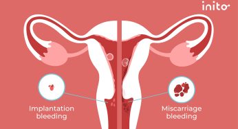 Health Voices Uganda - What's implantation bleeding and is it normal?  Implantation bleeding — typically defined as a small amount of light  spotting or bleeding that occurs about 10 to 14 days