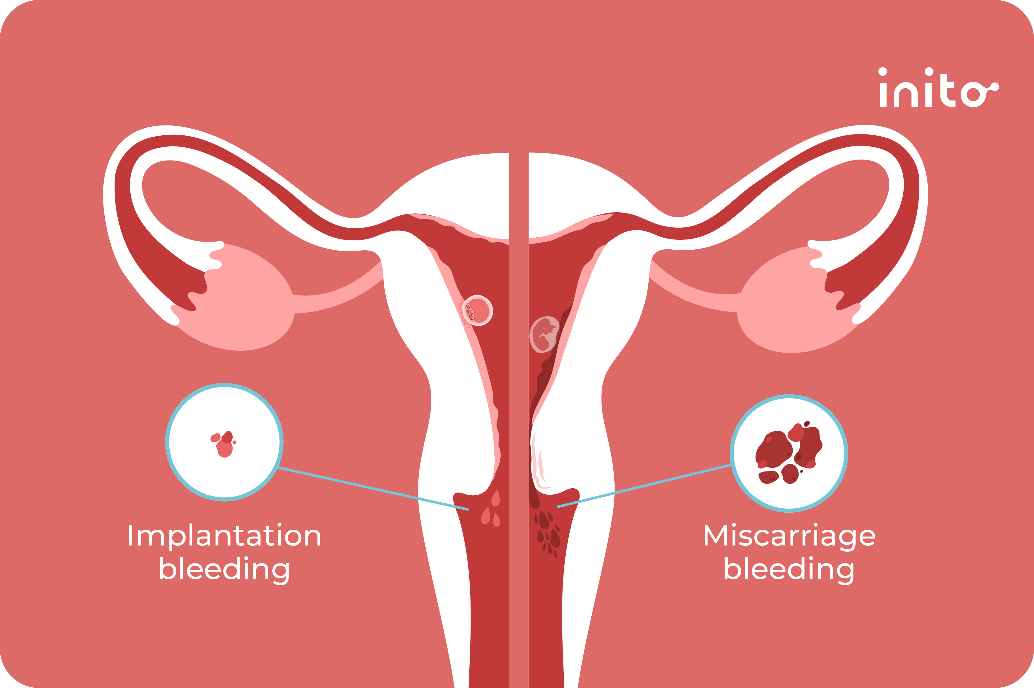 Implantation-Bleeding-vs.-Miscarriage