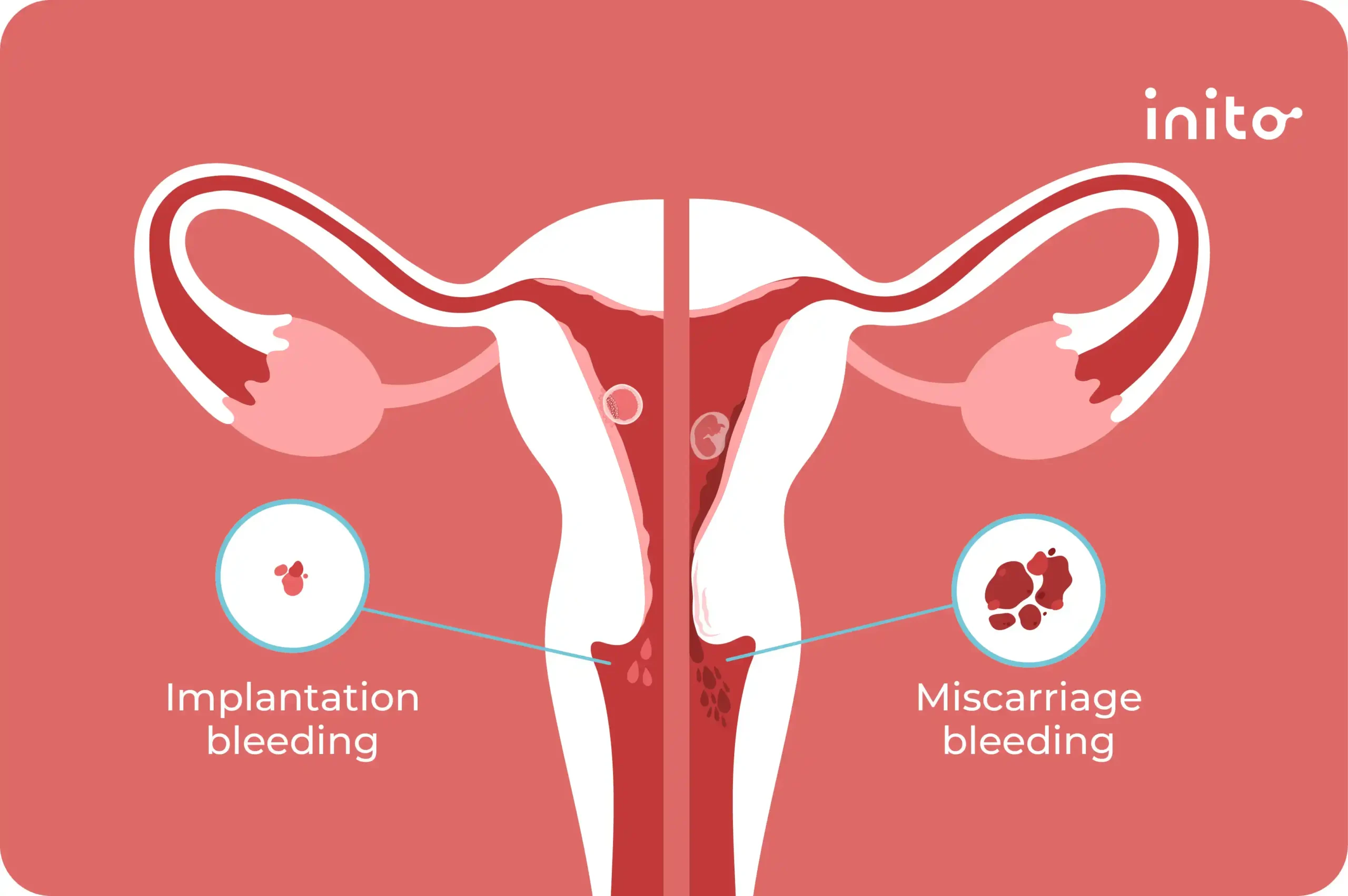 Bleeding between periods after miscarriage sale