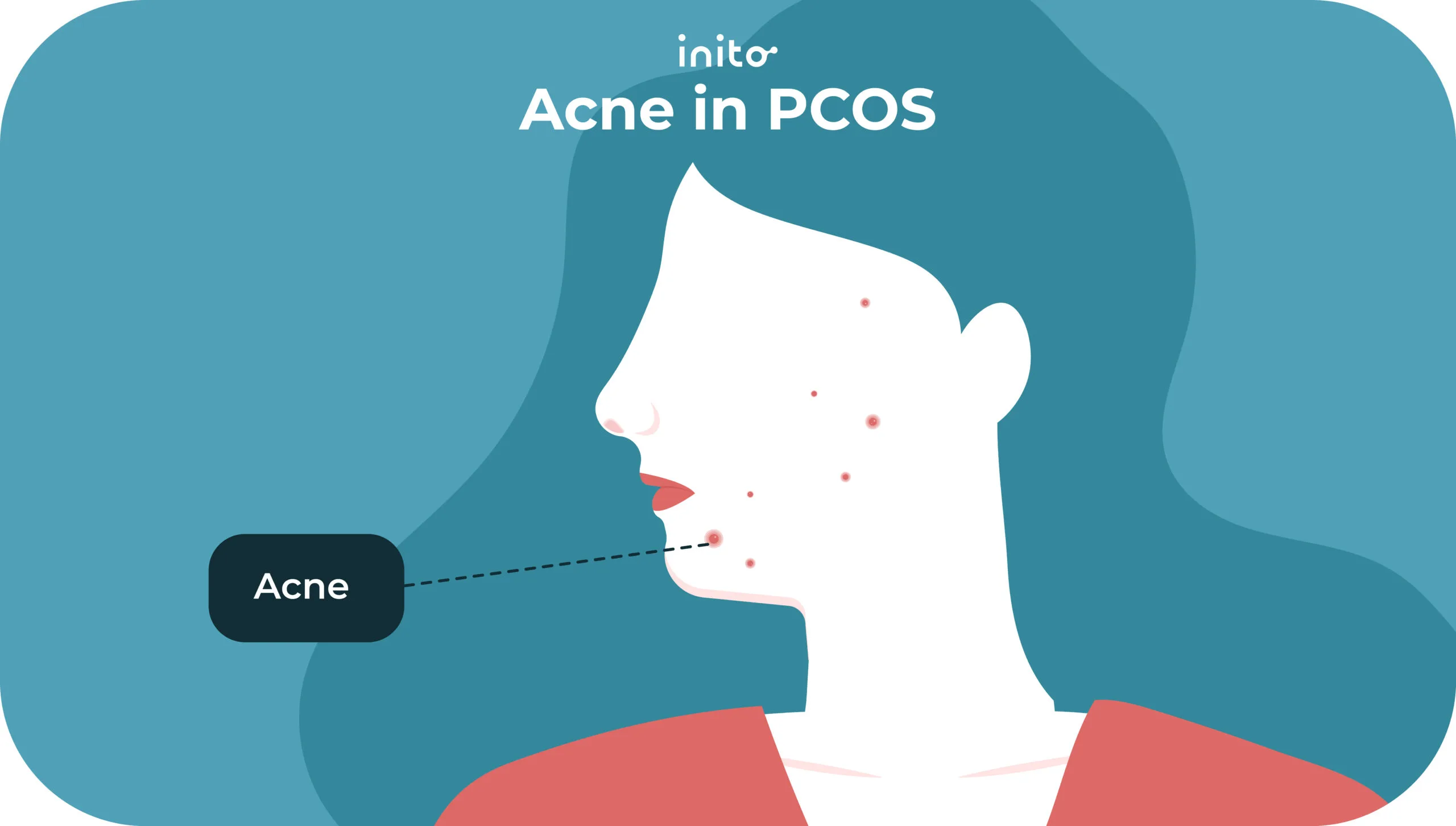 Acne in pcos