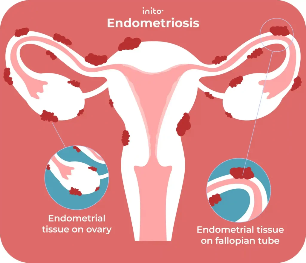 Endometriosis