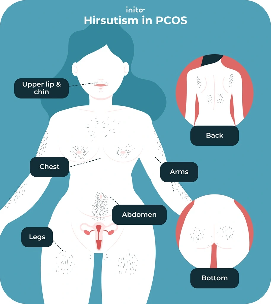 Hirsutism in PCOS