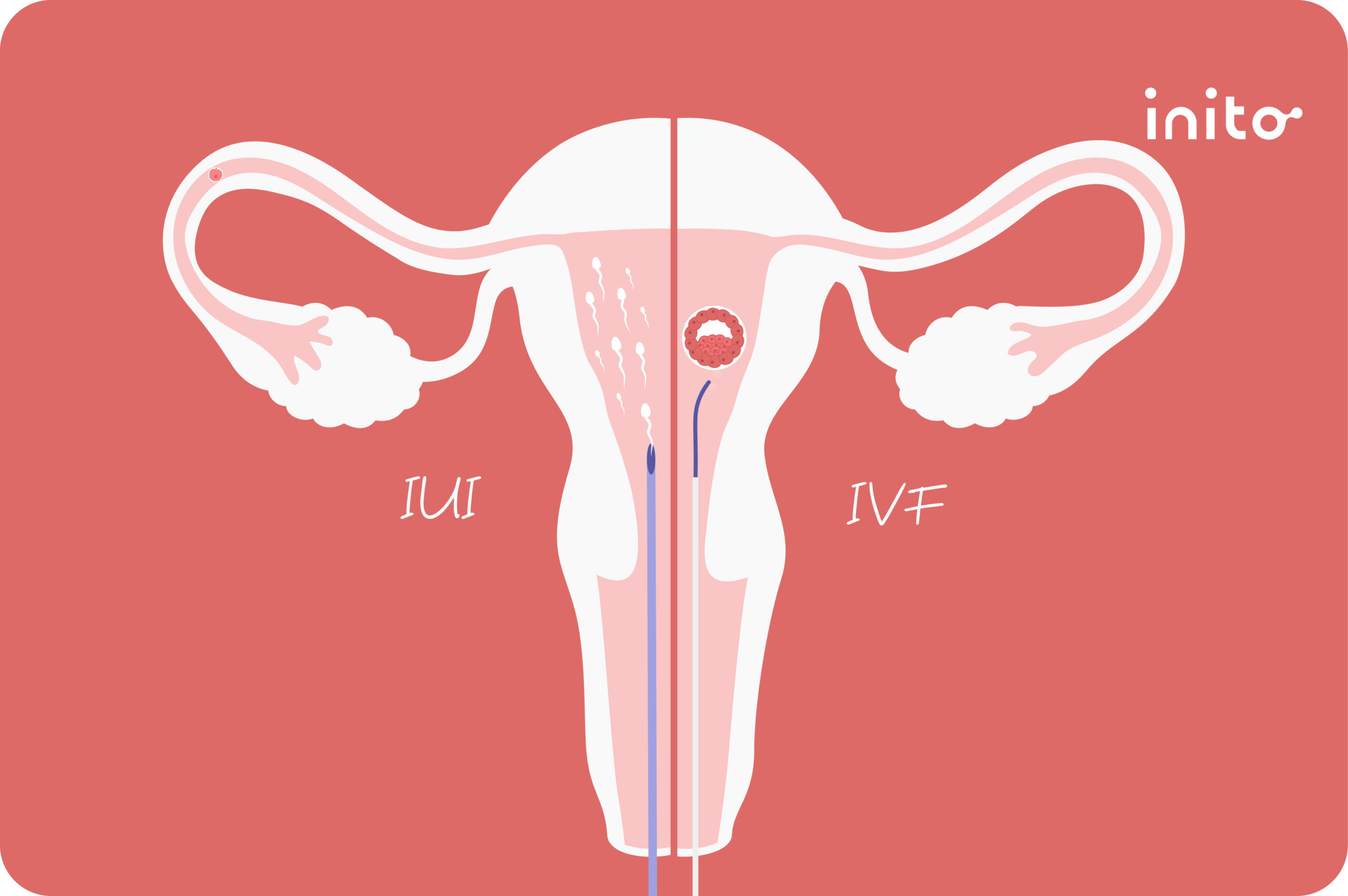 IUI Vs Ivf