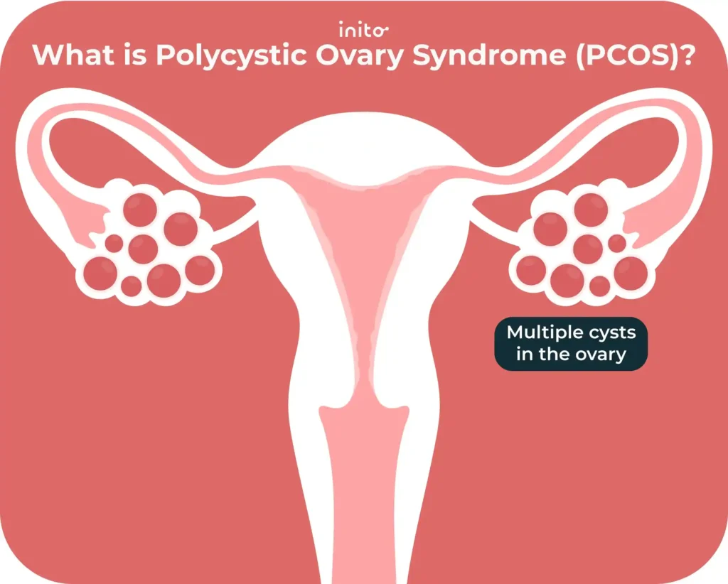 What is PCOS