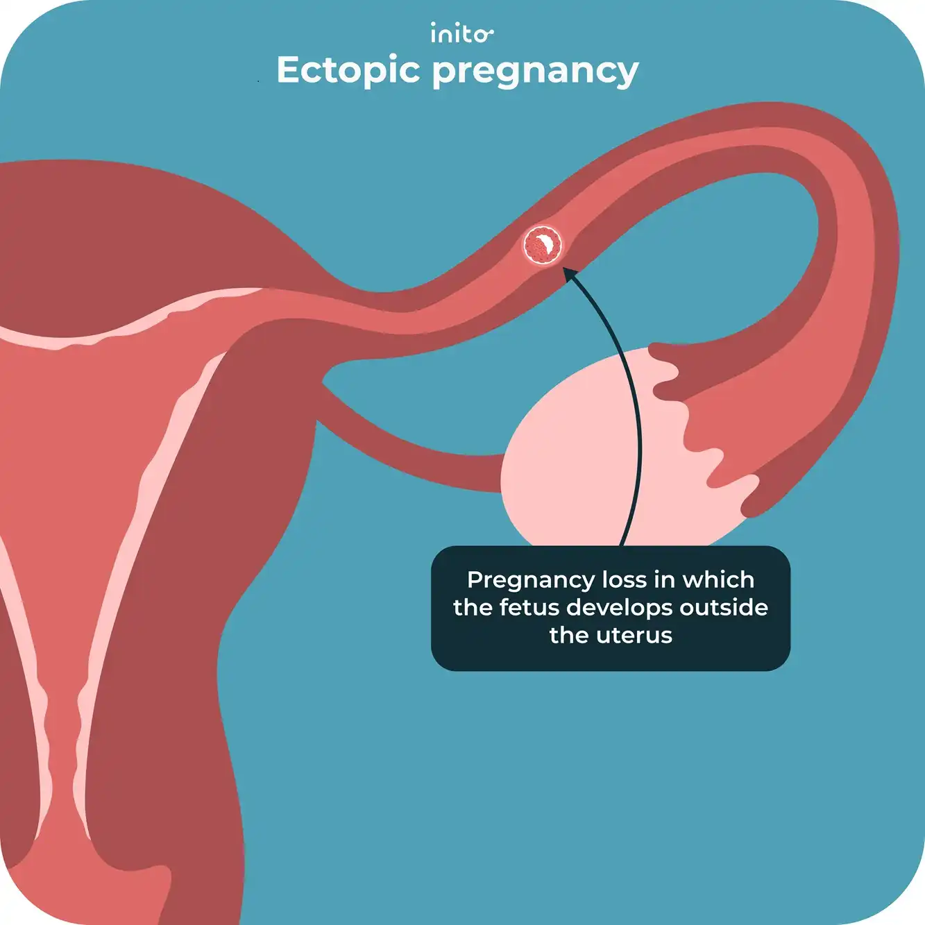 Ectopic pregnancy