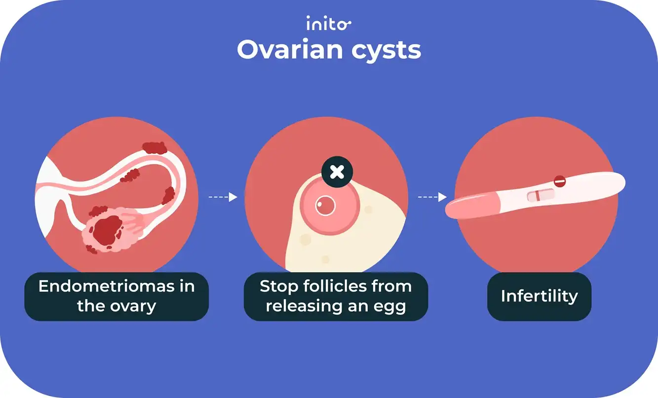 Ovarian cysts