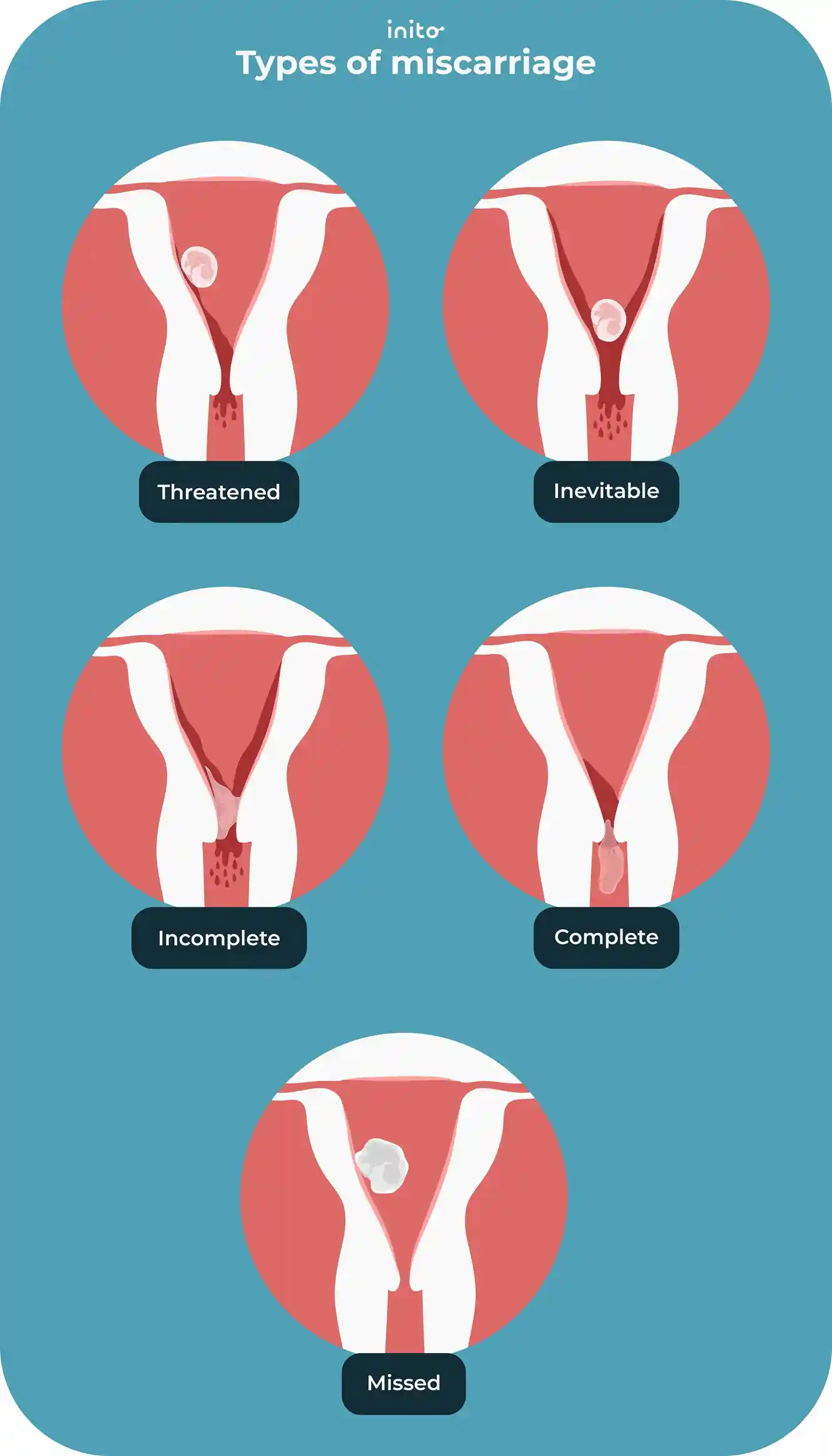 Types of miscarriage