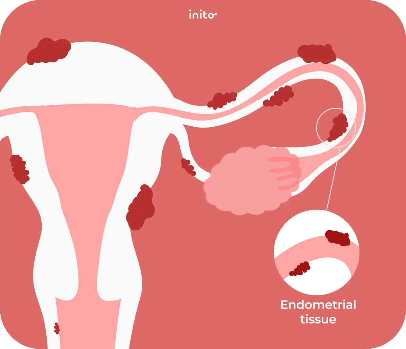 What is endometriosis?