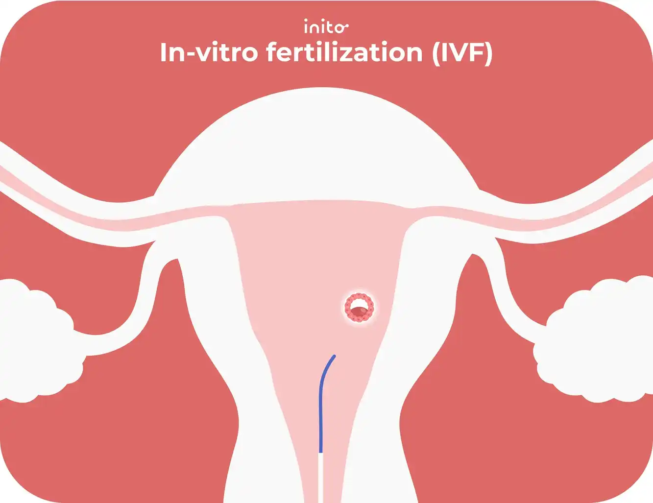 In-vitro fertilization(IVF)