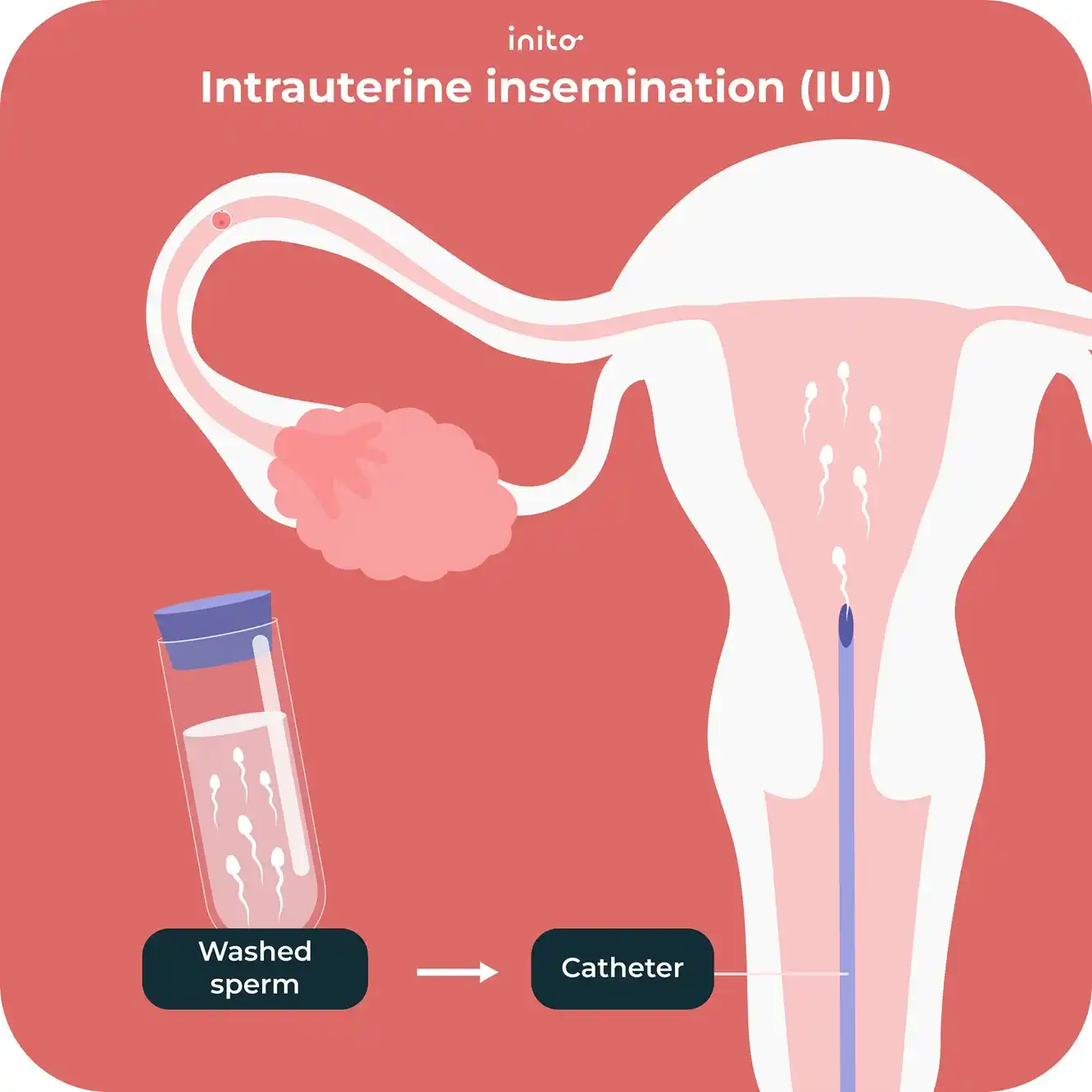 Intrauterine insemination(IUI)