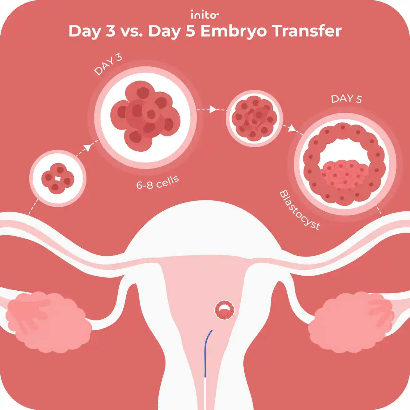 Day 3 vs. Day 5 Embryo Transfer