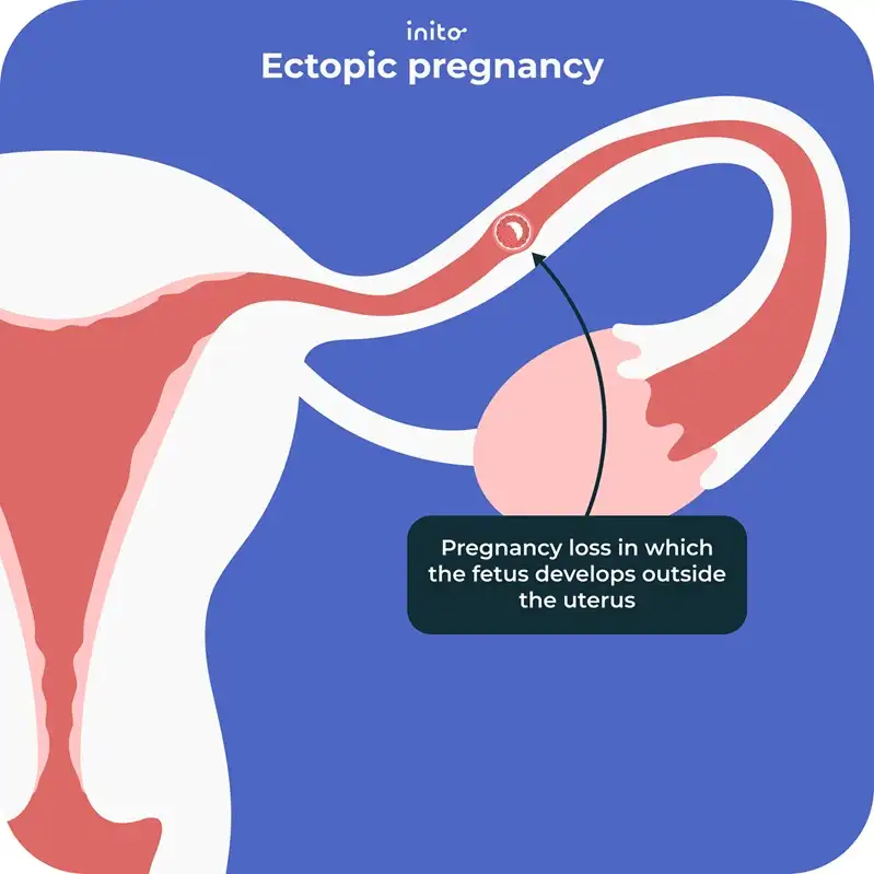 Ectopic pregnancy