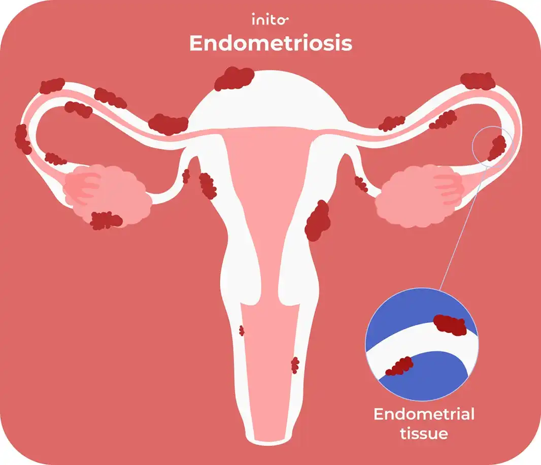 What is endometriosis?