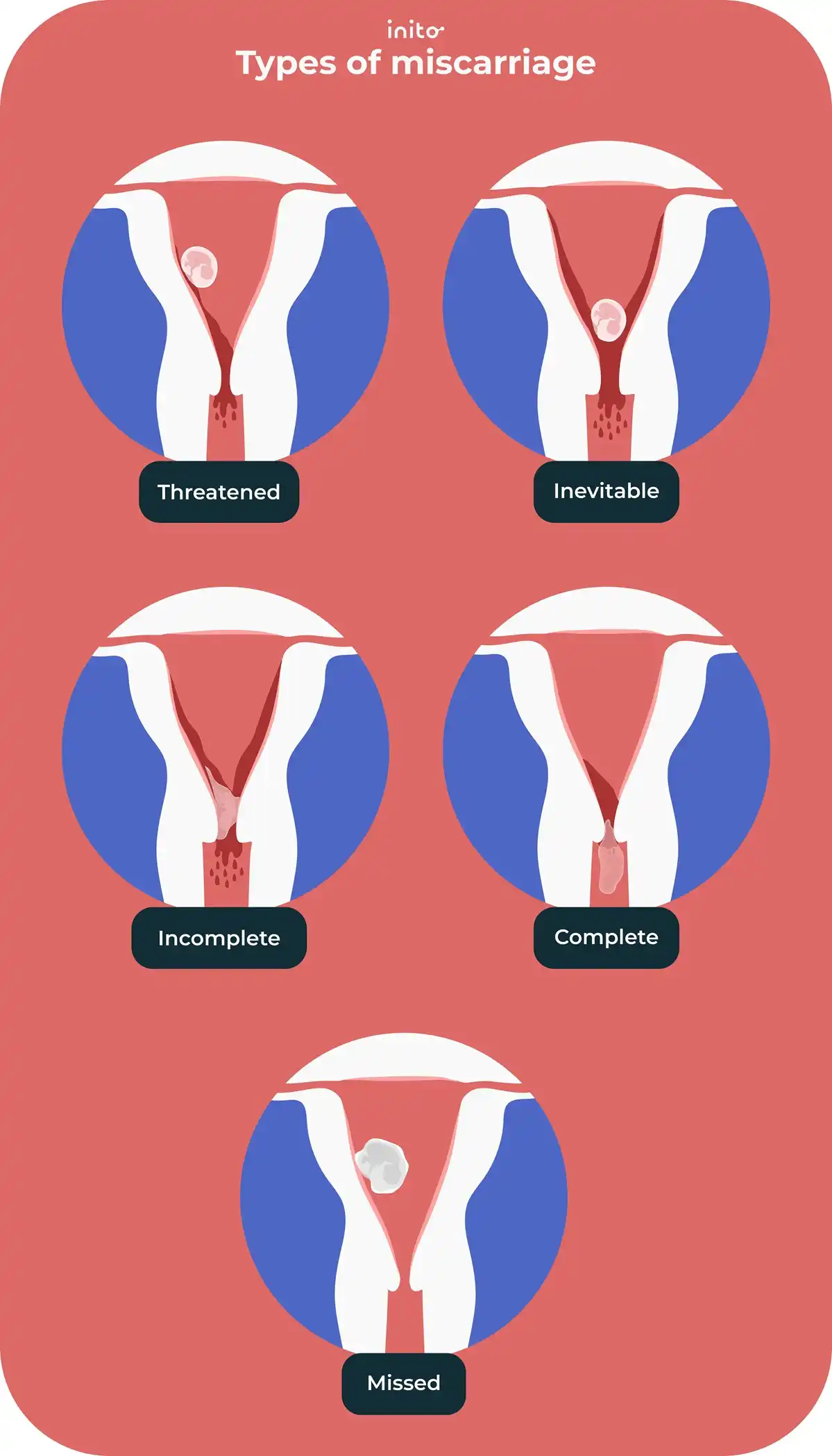 types of miscarriage