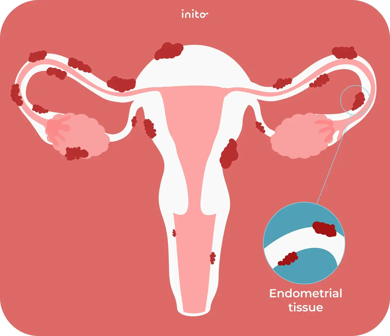 Effect of endometriosis on menstrual cycle