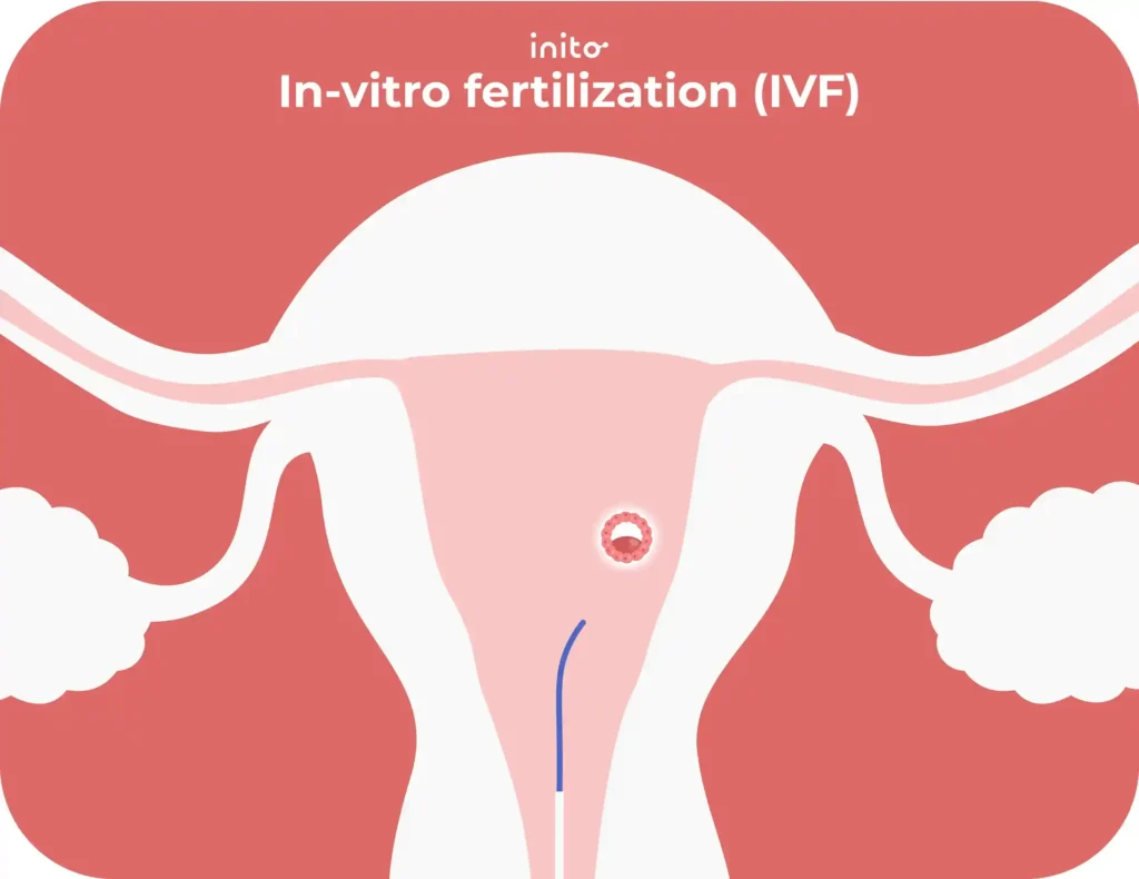 in vitro fertilization