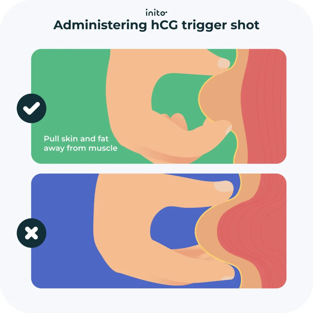 Administering hCG trigger shot
