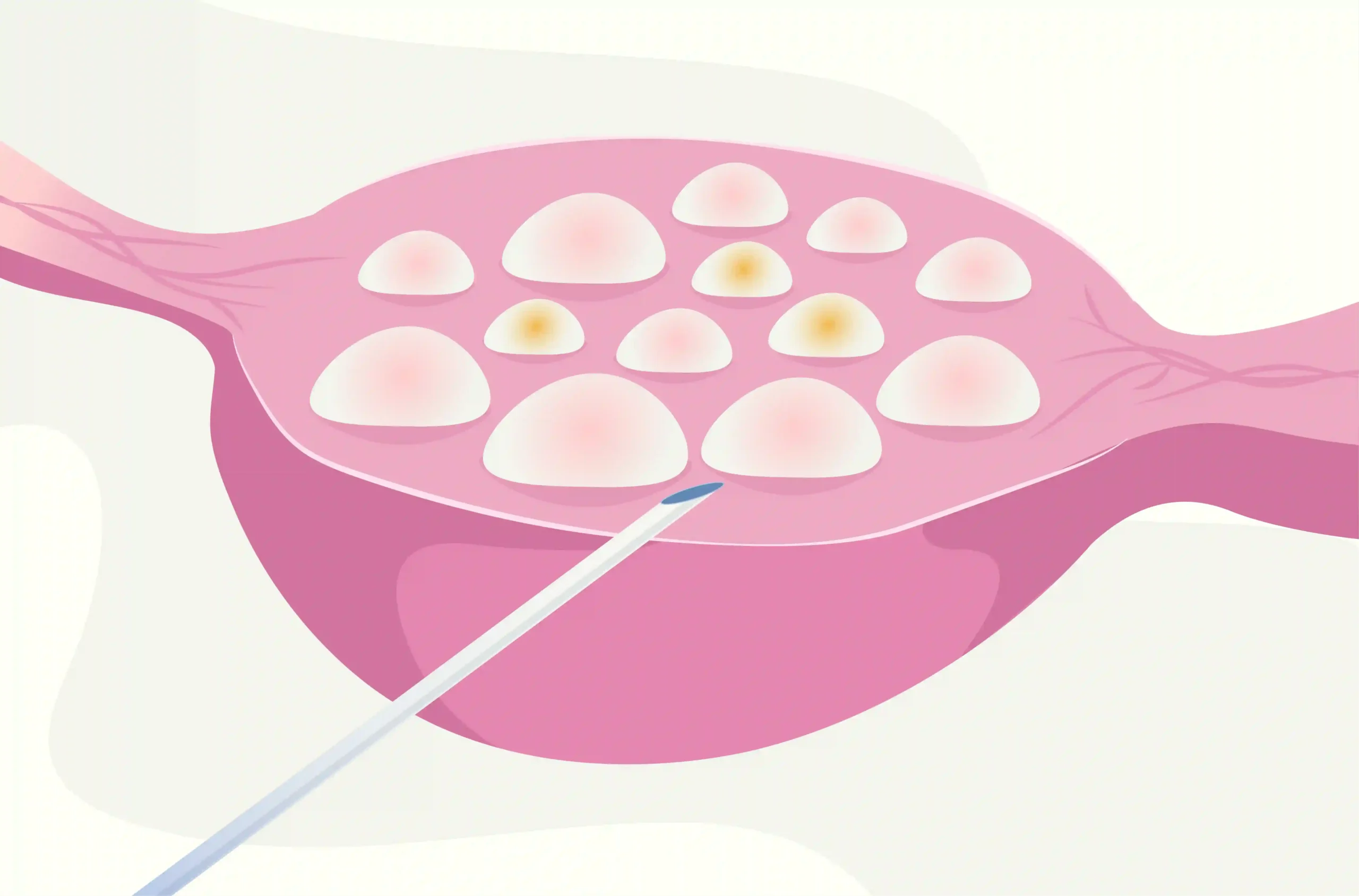 ivf cost​